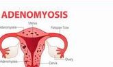 子宫腺肌症可以做三代试管吗？